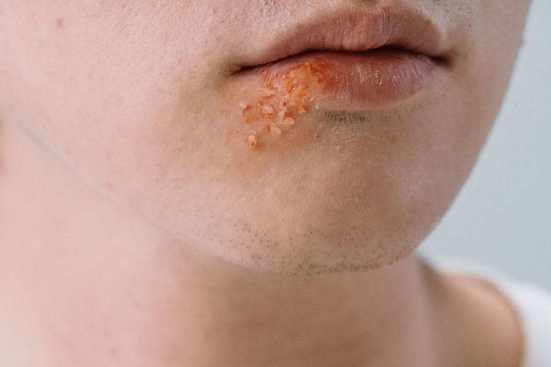 Kje vas boli – herpes