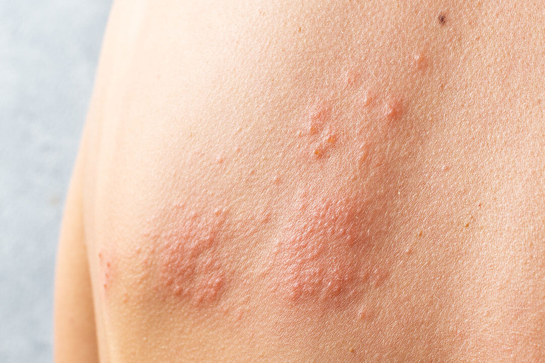 Kje vas boli – Herpes zoster (pasovec)